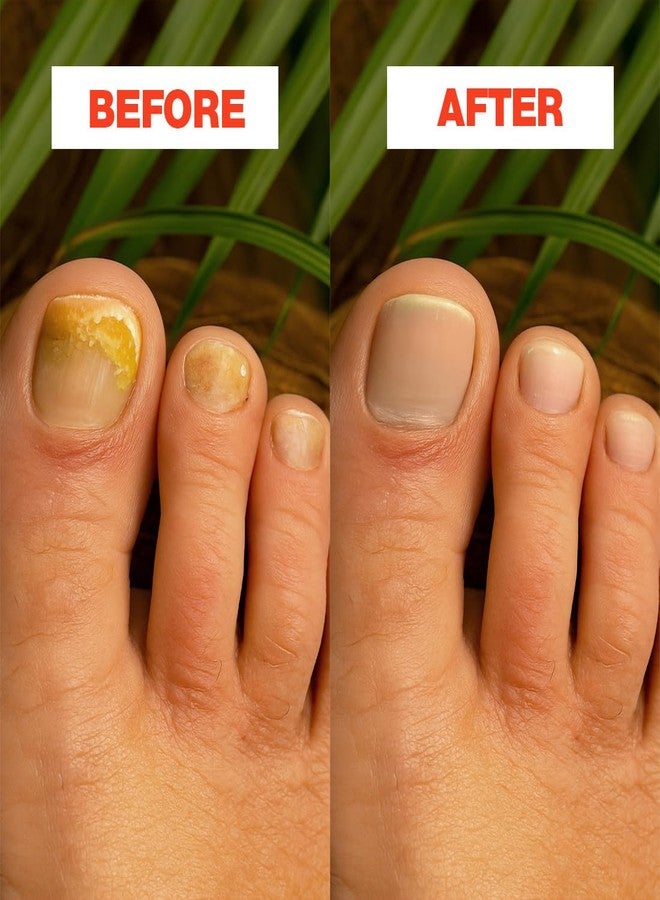 Probelle Natural Nail Renewal Gel, Clear Nail Enhancer for Discolored, Damaged, or Dull Nails, Improves Color Appearance, Promotes Smooth Healthy-Looking Nails, Made in USA (1 Pack) - Image 3